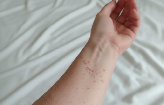 Secretaría de Salud confirmó primer caso de sarampión en Puebla