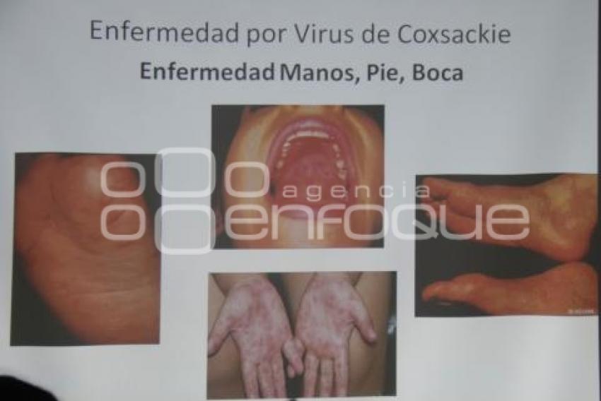 IMSS . VIRUS COXSACKIE